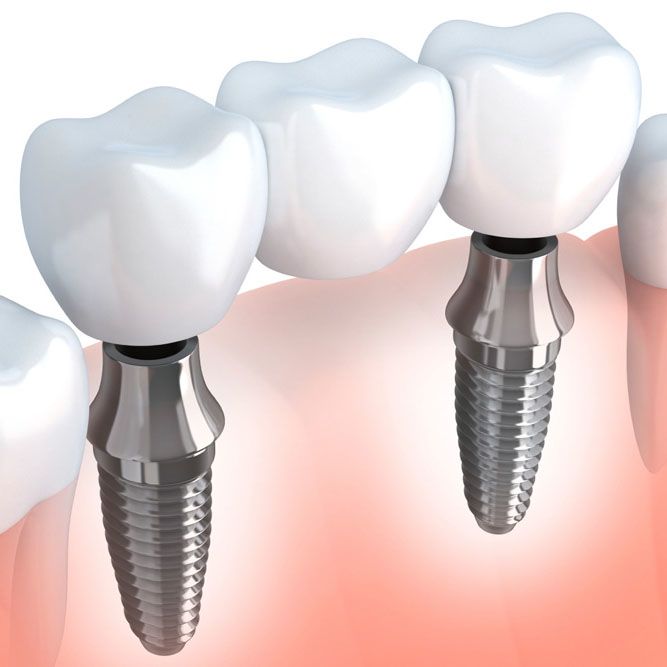 Illustration of an implant-supported bridge