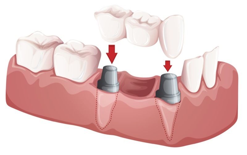 Illustration of a dental bridge.