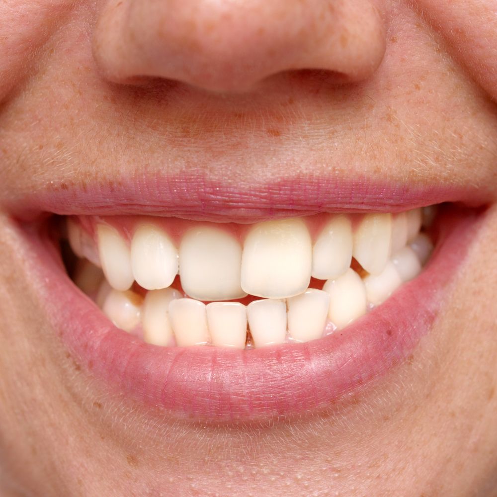 Misaligned teeth