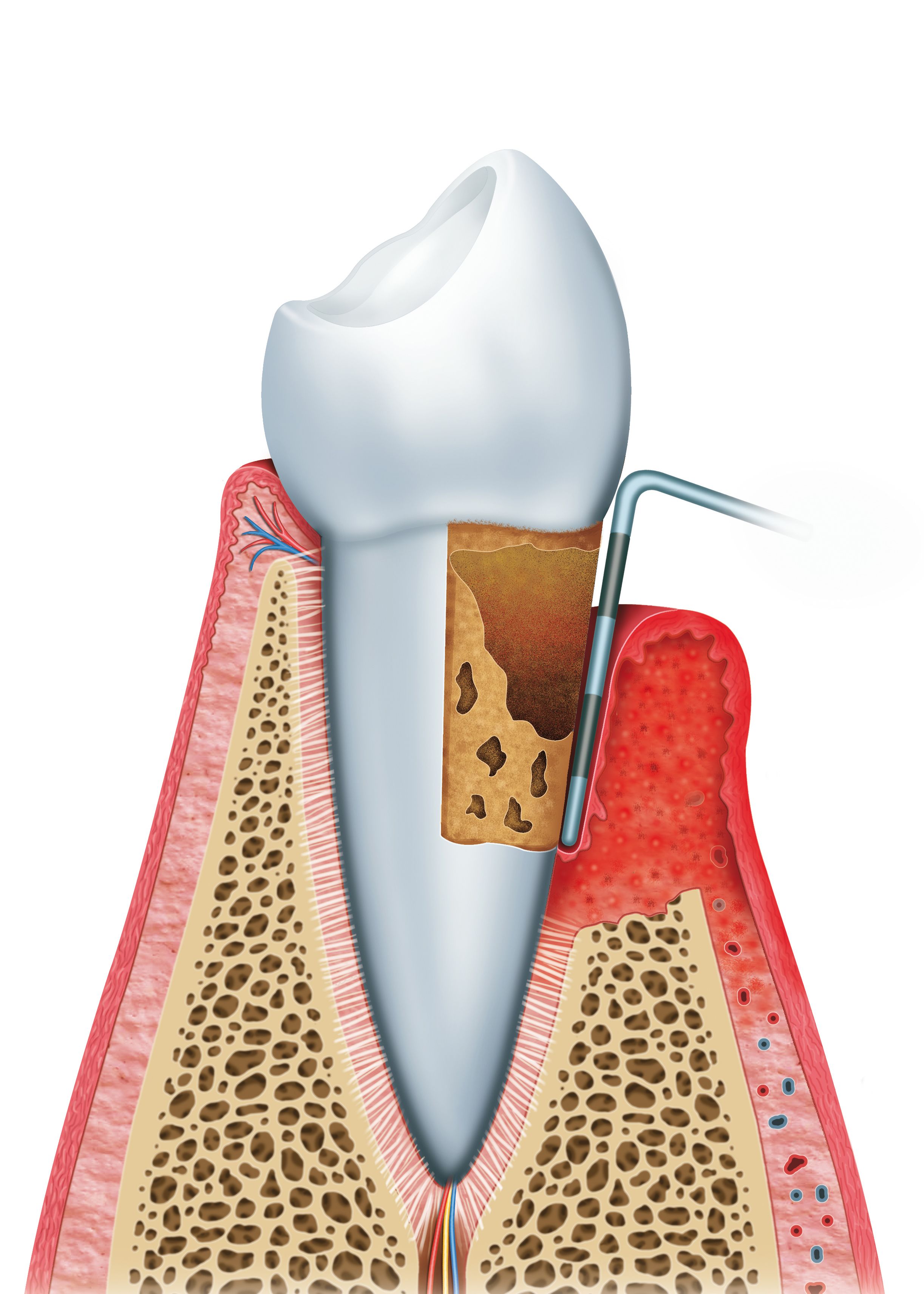Illustration of how plaque is removed from below the gum line.