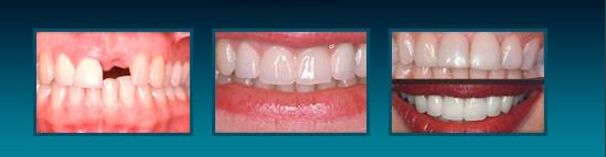 Patient with a missing tooth and patient with the tooth replaced.