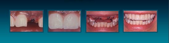Before showing gums with an implant and after showing smile with restoration