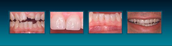 Before showing broken and worn teeth and after showing repaired teeth.
