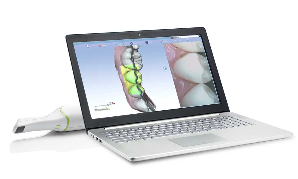 E4D scanner and laptop showing digital impression of teeth