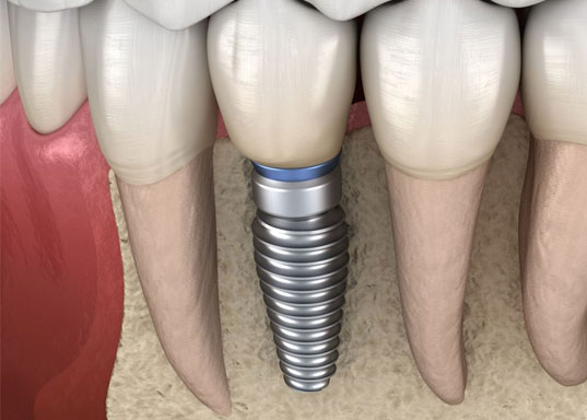 A cutaway showing a dental implant