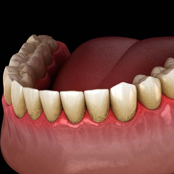 An illustration of plaque building up along the gum line