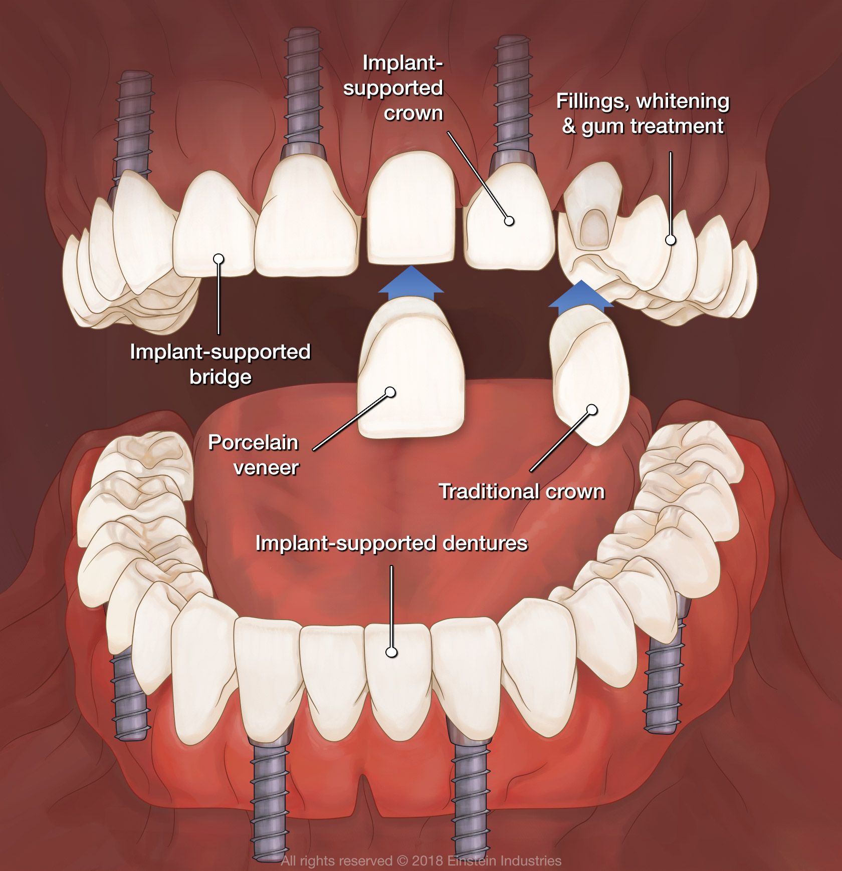 graphic showing implant and implant-supported restoration types