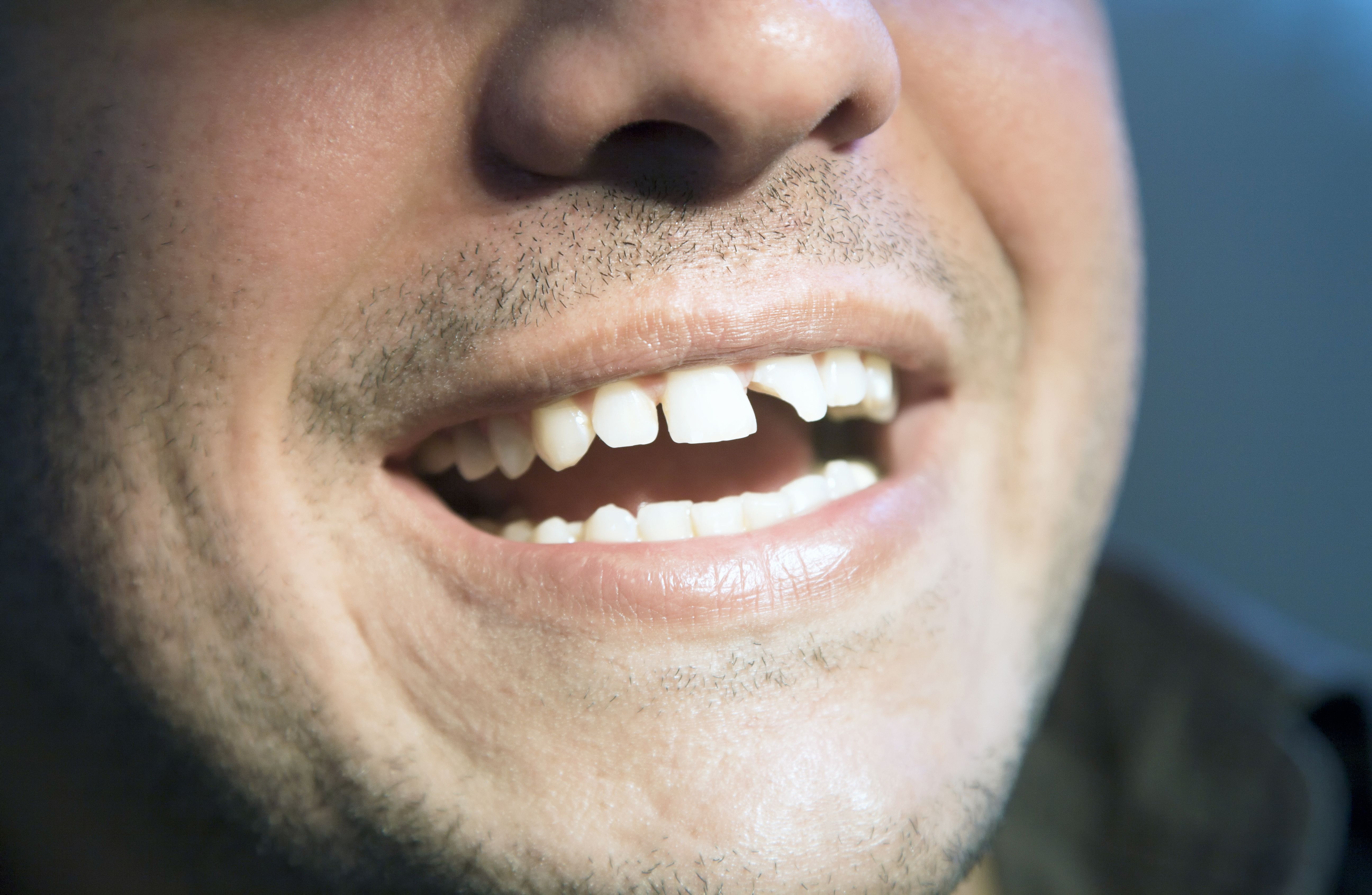A man with a chipped tooth