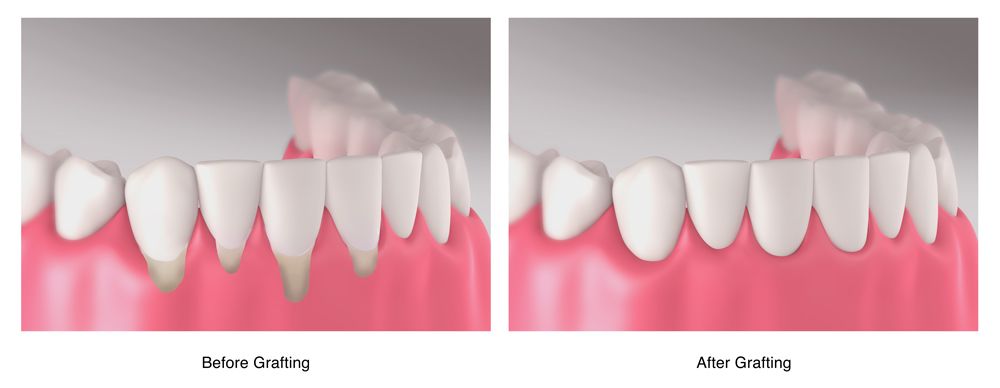 before and after gum graft